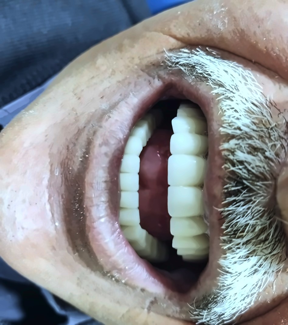 אחרי: שיניים גמורות